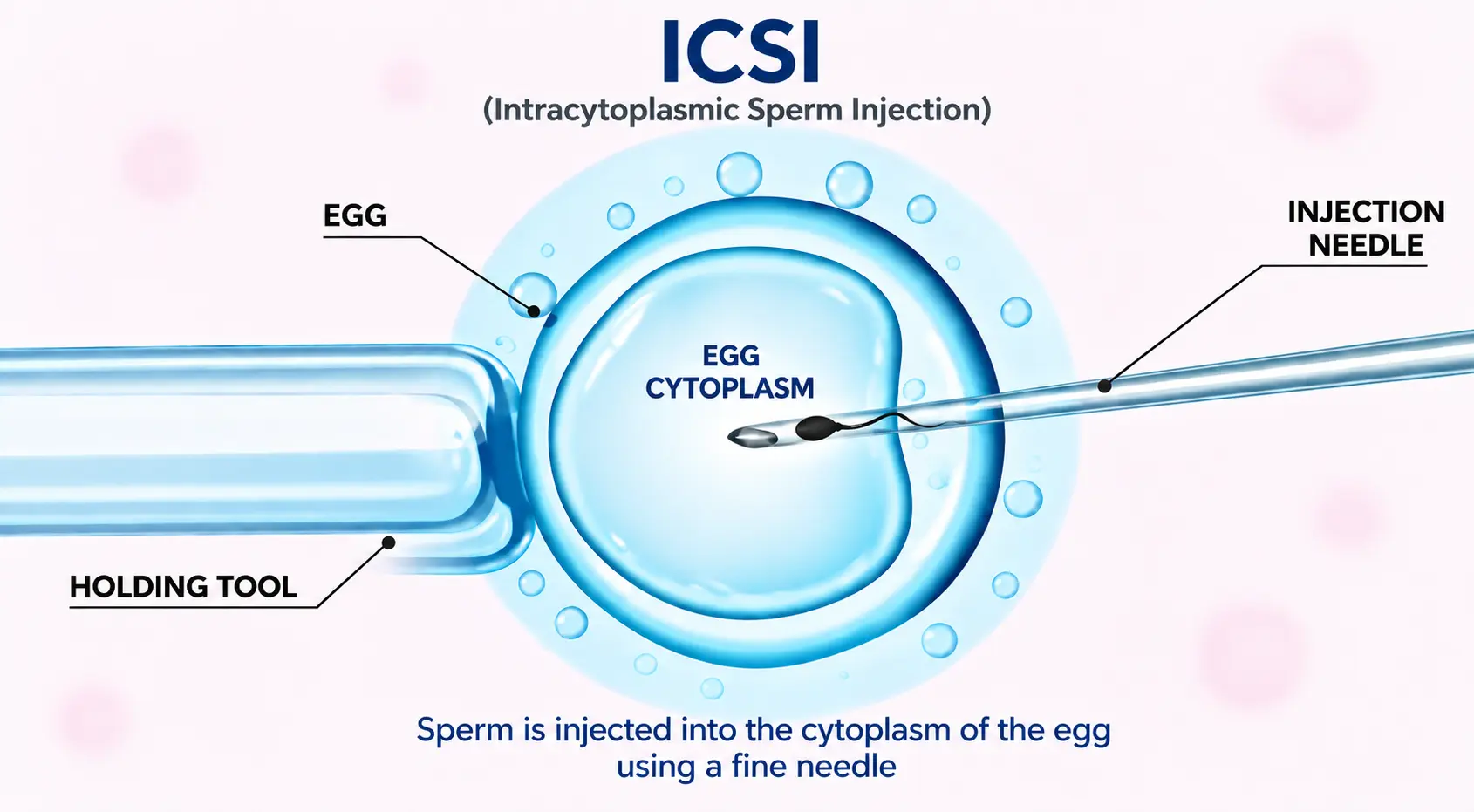 Intracytoplasmic Sperm Injection (ICSI) Patna